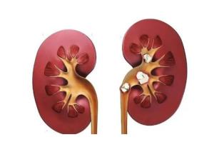 C:\Users\Administrator\Desktop\微信推送2025年第51期(总第414期)\04 肾内科-疼到直不起腰?小心身体里长了 “小石头”!\图片\图片1.jpg C:\Users\Administrator\Desktop\微信推送2025年第51期(总第414期)\04 肾内科-疼到直不起腰?小心身体里长了 “小石头”!\图片\图片1.jpg