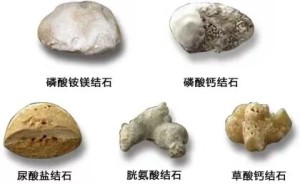 C:\Users\Administrator\Desktop\微信推送2025年第51期(总第414期)\04 肾内科-疼到直不起腰?小心身体里长了 “小石头”!\图片\图片2.jpg C:\Users\Administrator\Desktop\微信推送2025年第51期(总第414期)\04 肾内科-疼到直不起腰?小心身体里长了 “小石头”!\图片\图片2.jpg